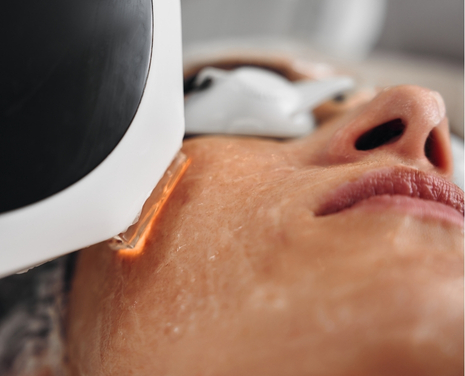 consulta ipl medicina estetica smp