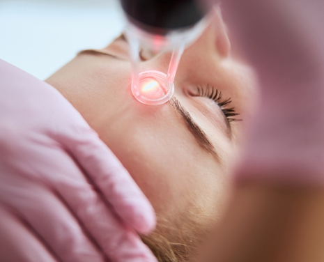 rejoveniment facial laser co2 smp